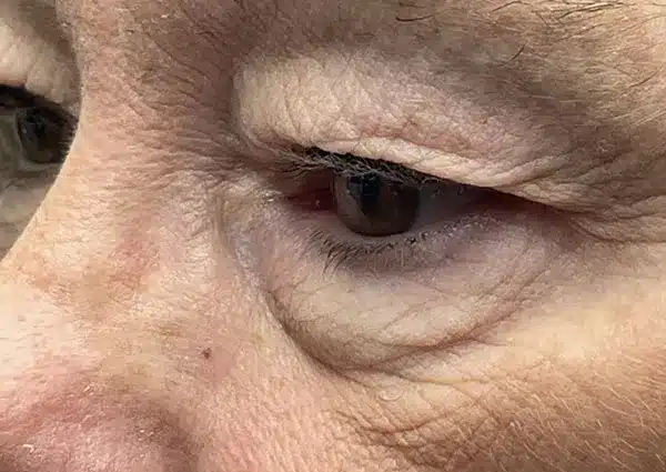 Upper Lid Blepharoplasty (upper eyelid lift)