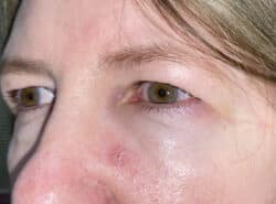 Upper Lid Blepharoplasty (upper eyelid lift)