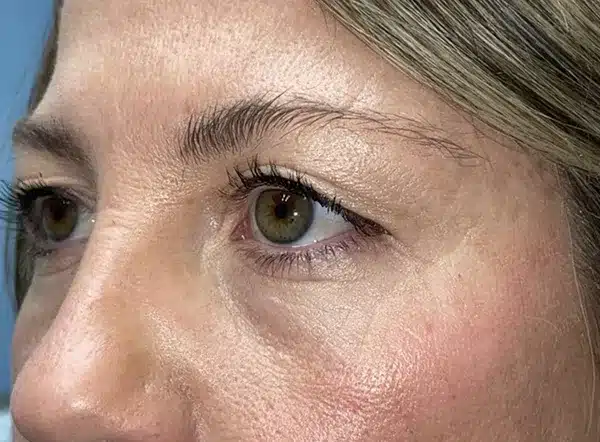 Upper Lid Blepharoplasty (upper eyelid lift)