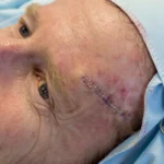 Mohs Surgery 1 Middle aged man post-op MOHS surgery