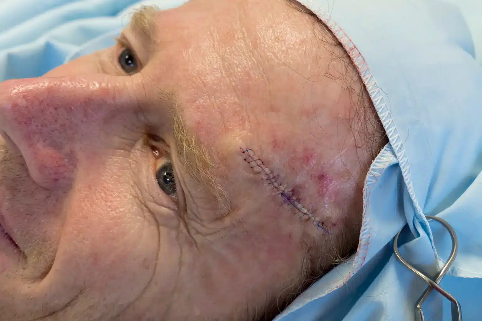 Middle aged man post-op MOHS surgery