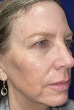 CO2 Laser Resurfacing (wrinkle/line reduction)