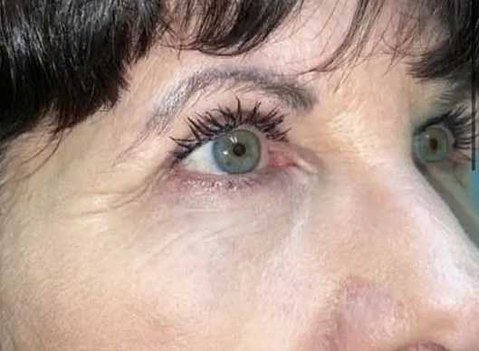 Combination Surgeries (eyelid lift and other)
