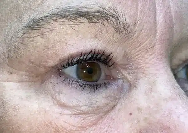 Upper Lid Blepharoplasty (upper eyelid lift)