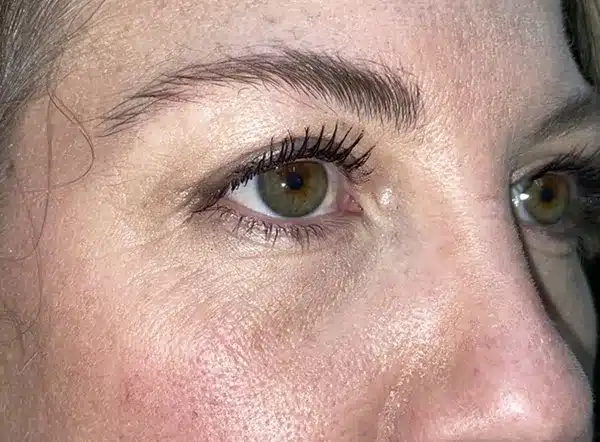 Upper Lid Blepharoplasty (upper eyelid lift)