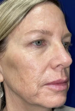 CO2 Laser Resurfacing (wrinkle/line reduction)