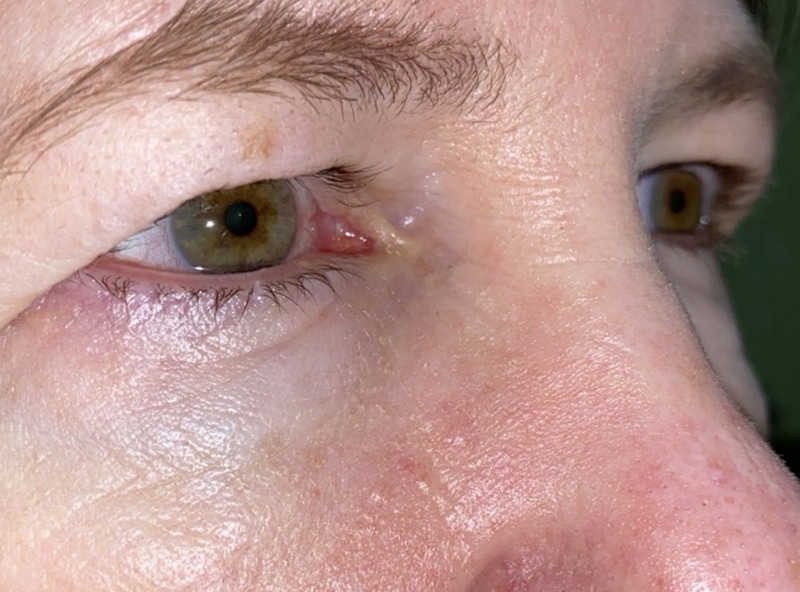 Upper Lid Blepharoplasty (upper eyelid lift)