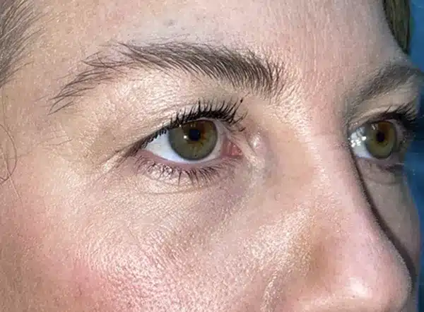 Upper Lid Blepharoplasty (upper eyelid lift)