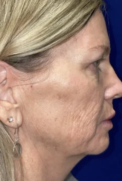 CO2 Laser Resurfacing (wrinkle/line reduction)