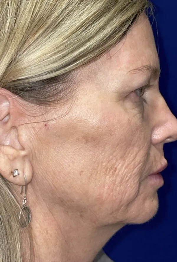 CO2 Laser Resurfacing (wrinkle/line reduction)