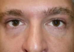 Brow/Forehead Lift