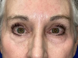 Brow/Forehead Lift