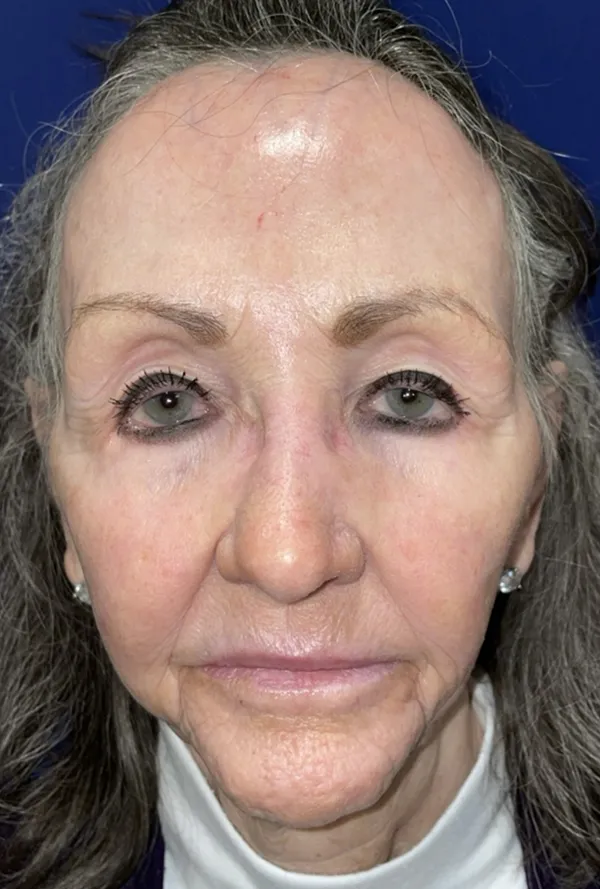 CO2 Laser Resurfacing (wrinkle/line reduction)