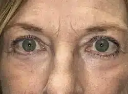 Combination Surgeries (eyelid lift and other)