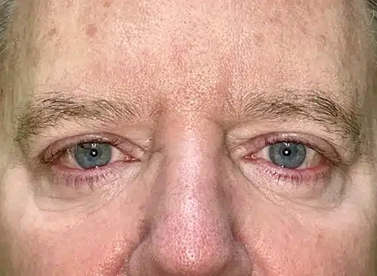Combination Surgeries (eyelid lift and other)