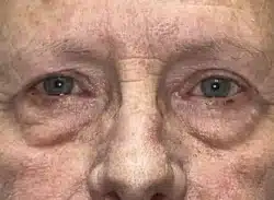 Combination Surgeries (eyelid lift and other)