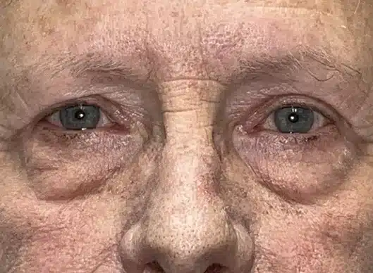 Combination Surgeries (eyelid lift and other)