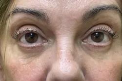 Lower Lid Blepharoplasty (lower eyelid eyelift)