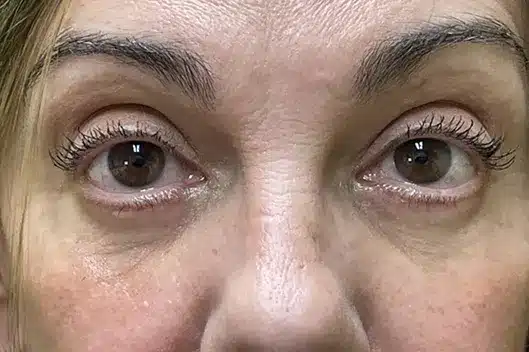 Lower Lid Blepharoplasty (lower eyelid eyelift)