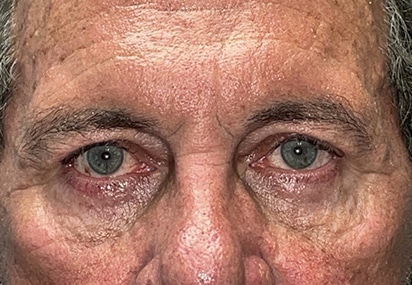 Upper/Lower Lid Blepharoplasty