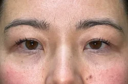 Upper Lid Blepharoplasty (upper eyelid lift)