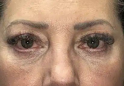 Upper/Lower Lid Blepharoplasty