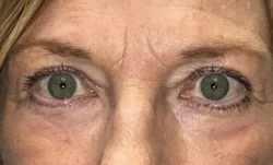 Upper/Lower Lid Blepharoplasty