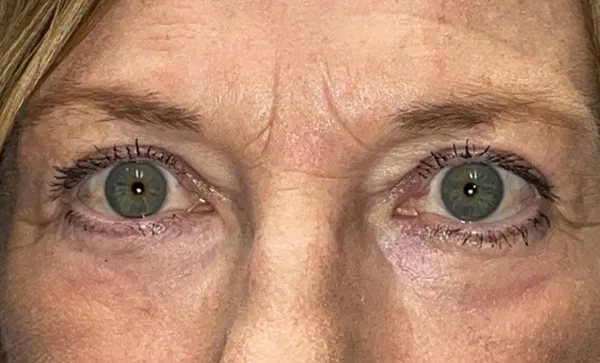 Upper/Lower Lid Blepharoplasty