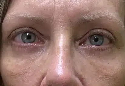 Upper/Lower Lid Blepharoplasty