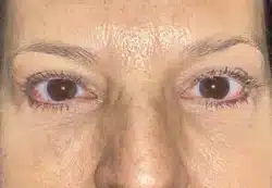 Upper/Lower Lid Blepharoplasty