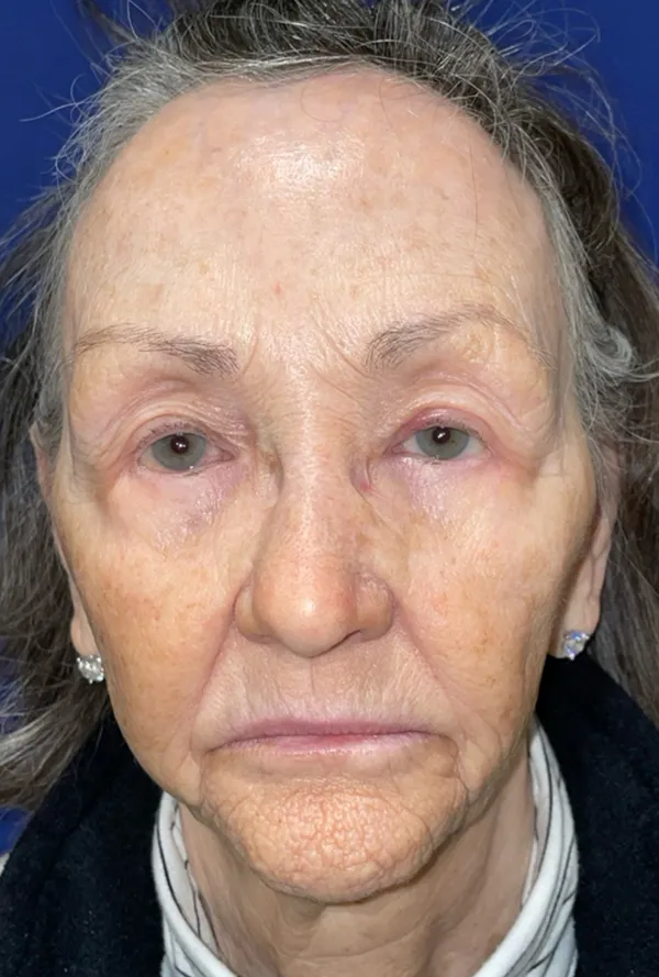 CO2 Laser Resurfacing (wrinkle/line reduction)