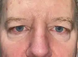 Combination Surgeries (eyelid lift and other)