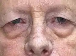 Combination Surgeries (eyelid lift and other)