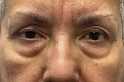 Lower Lid Blepharoplasty (lower eyelid eyelift)