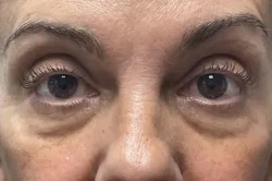 Lower Lid Blepharoplasty (lower eyelid eyelift)