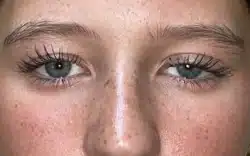 Eyelid Lift (Blepharoplasty/Ptosis Repair)