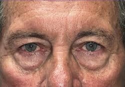 Upper/Lower Lid Blepharoplasty