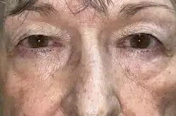 Upper Lid Blepharoplasty (upper eyelid lift)