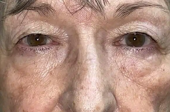 Upper Lid Blepharoplasty (upper eyelid lift)