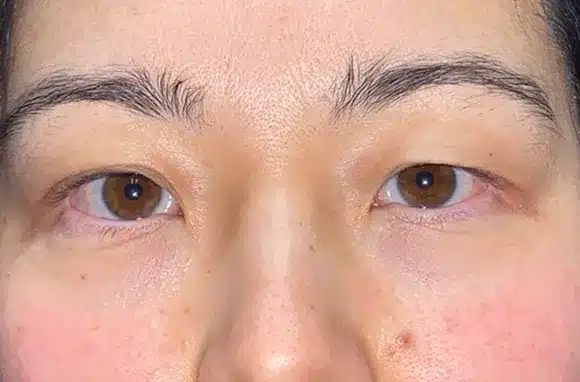Upper Lid Blepharoplasty (upper eyelid lift)