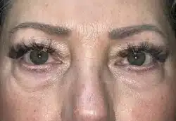 Upper/Lower Lid Blepharoplasty