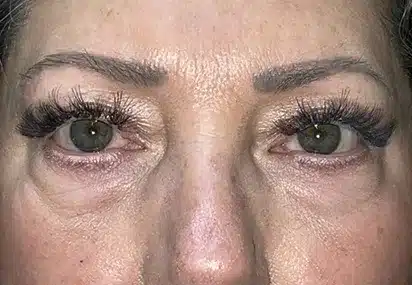 Upper/Lower Lid Blepharoplasty