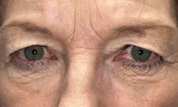 Upper/Lower Lid Blepharoplasty