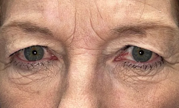 Upper/Lower Lid Blepharoplasty