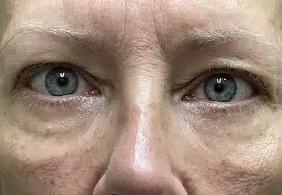 Upper/Lower Lid Blepharoplasty