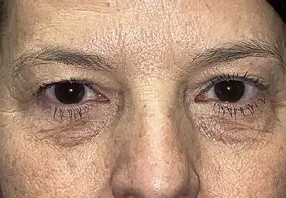 Upper/Lower Lid Blepharoplasty