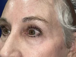 Brow/Forehead Lift