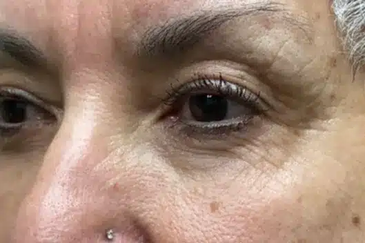 Lower Lid Blepharoplasty (lower eyelid eyelift)