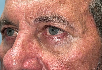 Upper/Lower Lid Blepharoplasty