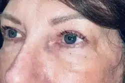 Upper Lid Blepharoplasty (upper eyelid lift)